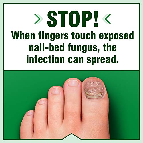 UNGICURE Intensive Spray, Antifungal Treatment, Kills 6 Types of Fungus, Soothes Itching & Burning, 2 Fl Oz (Pack of 1)