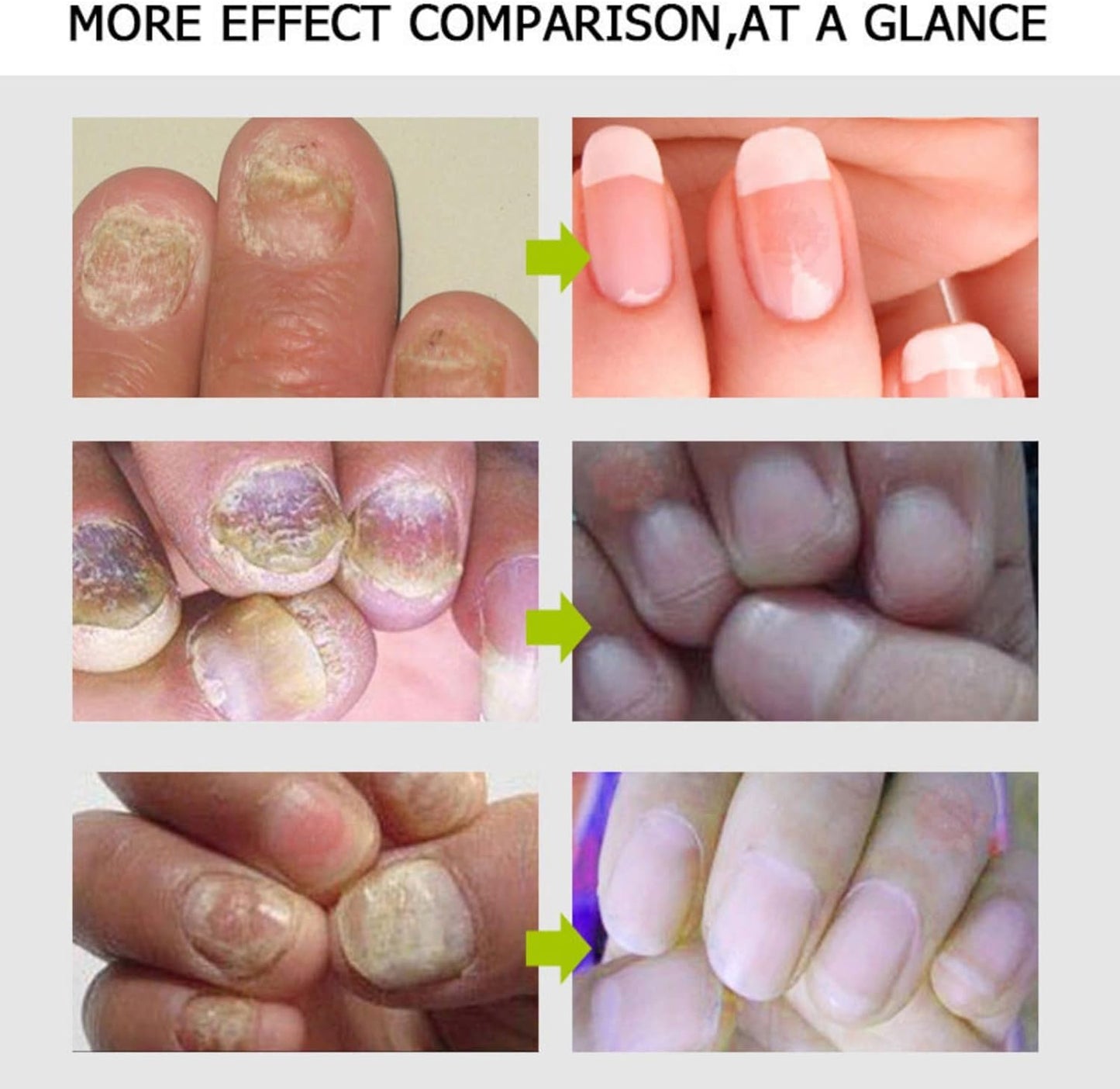 2PCS Nail Treatment Repair Gel, Fungal Nail Treatment Nail Repair Gel, Toe Be Health Instant 7 Days Beauty Gel, Toenail Treatment & Cure Under the Nail, for Damaged Nail.