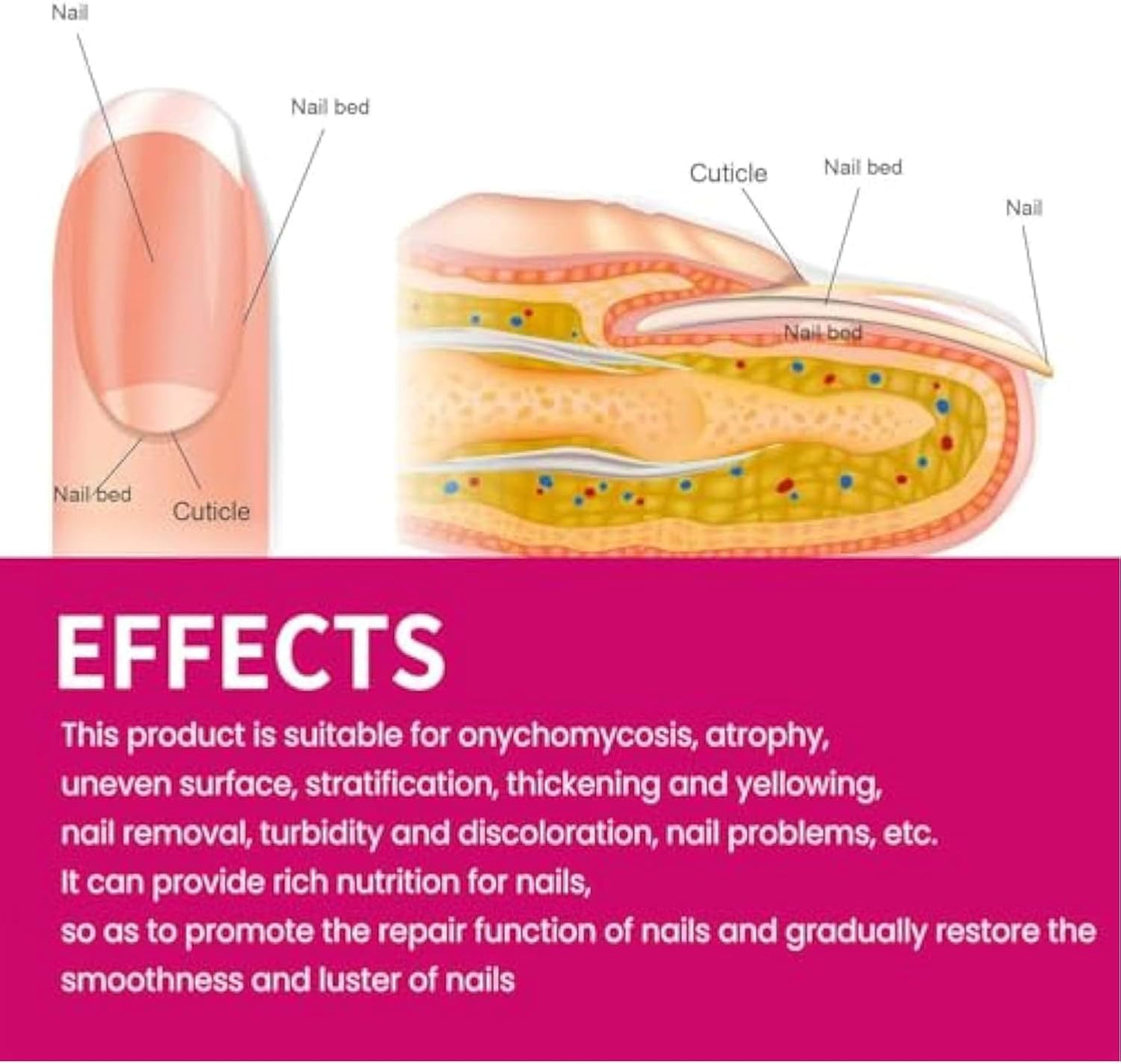 Fungigone Nail Treatment, Fungigone Nail Fungus Removal, Fungigones Ginger Nails Essence, Nailcare Extra Strong Toe for Toenail & Fingernail Care (2)