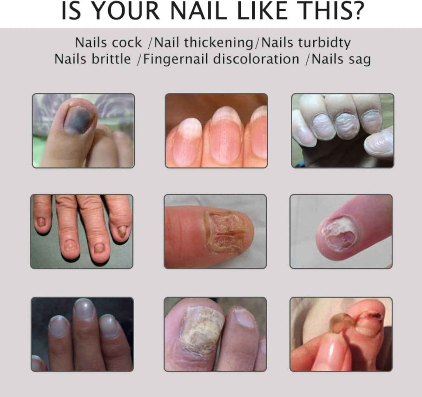 2PCS Nail Treatment Repair Gel, Fungal Nail Treatment Nail Repair Gel, Toe Be Health Instant 7 Days Beauty Gel, Toenail Treatment & Cure Under the Nail, for Damaged Nail.