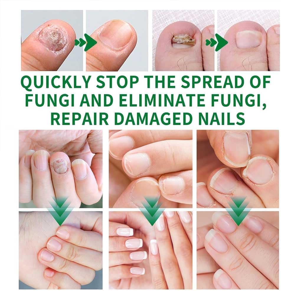 3Pcs 7 Days Ginger Nail Treatments, 7 Days Ginger Cuticle Care Oil For Nails, Ginger Nail Growth Serum, For Strengthen Nails & Promote Nail Growth, Natural Plant Formul