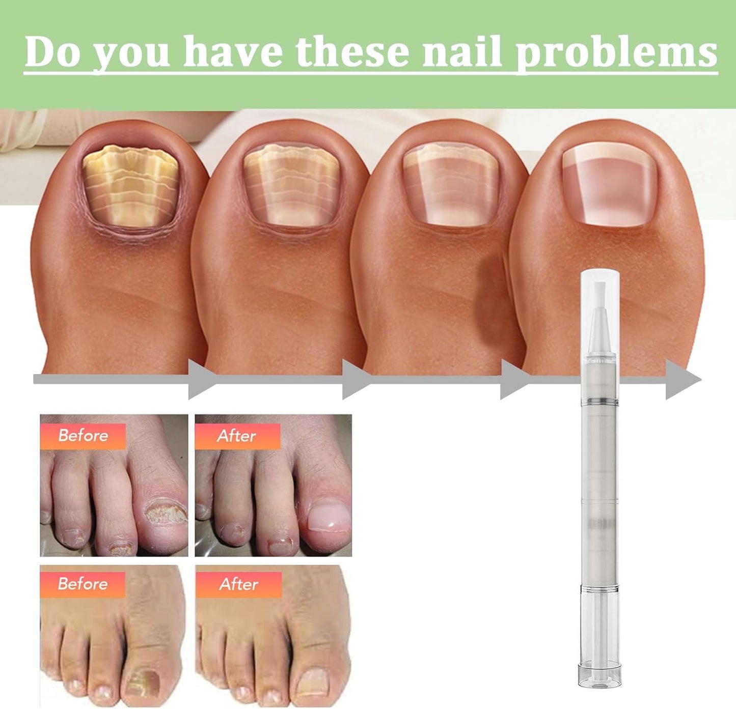 Nail Care Pen, Broken Nail Repair, Nail Care Pen, Nail Repair Pen