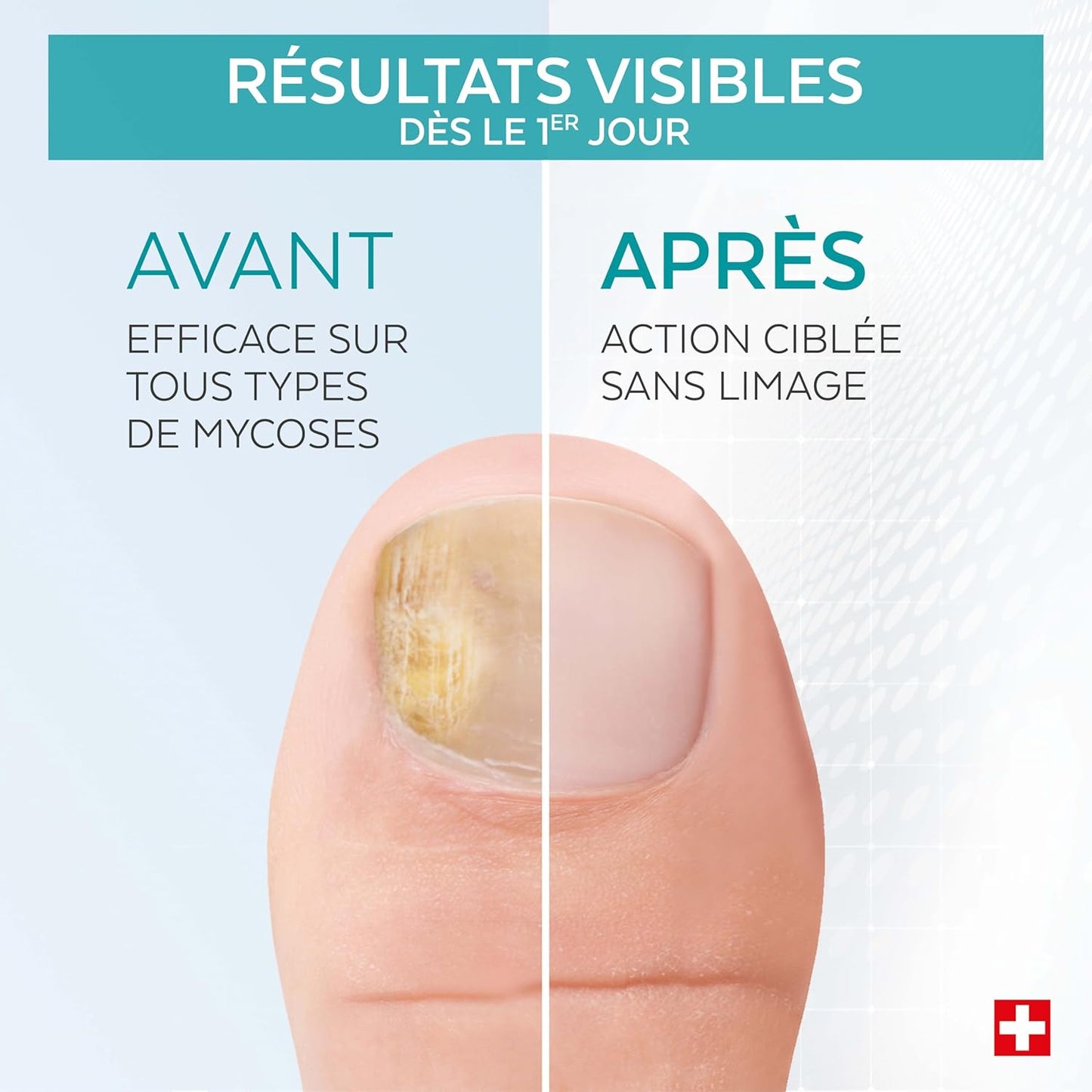 Poderm Nail Mycosis Treatment Serum Pen - Developed by a Podiatrist - Made in Switzerland - Supplend Pen for Hand and Foot Nail Care - Infection Treatment