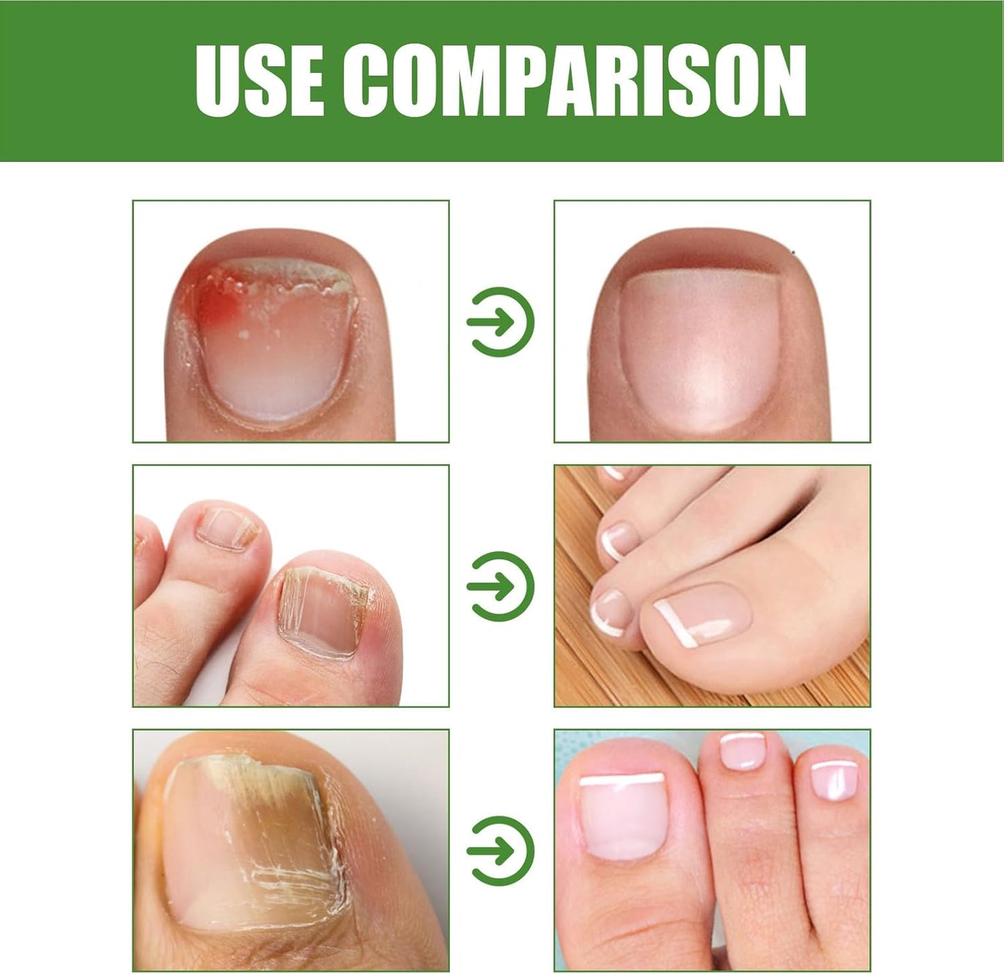 Iouyjiu Nail Strengthener Toenail Care Repair Cracked Nail Hydrating Formula Organic Ingredients 1 Stick Ideal for Fast and Effective Reliefs Home Use 10ml