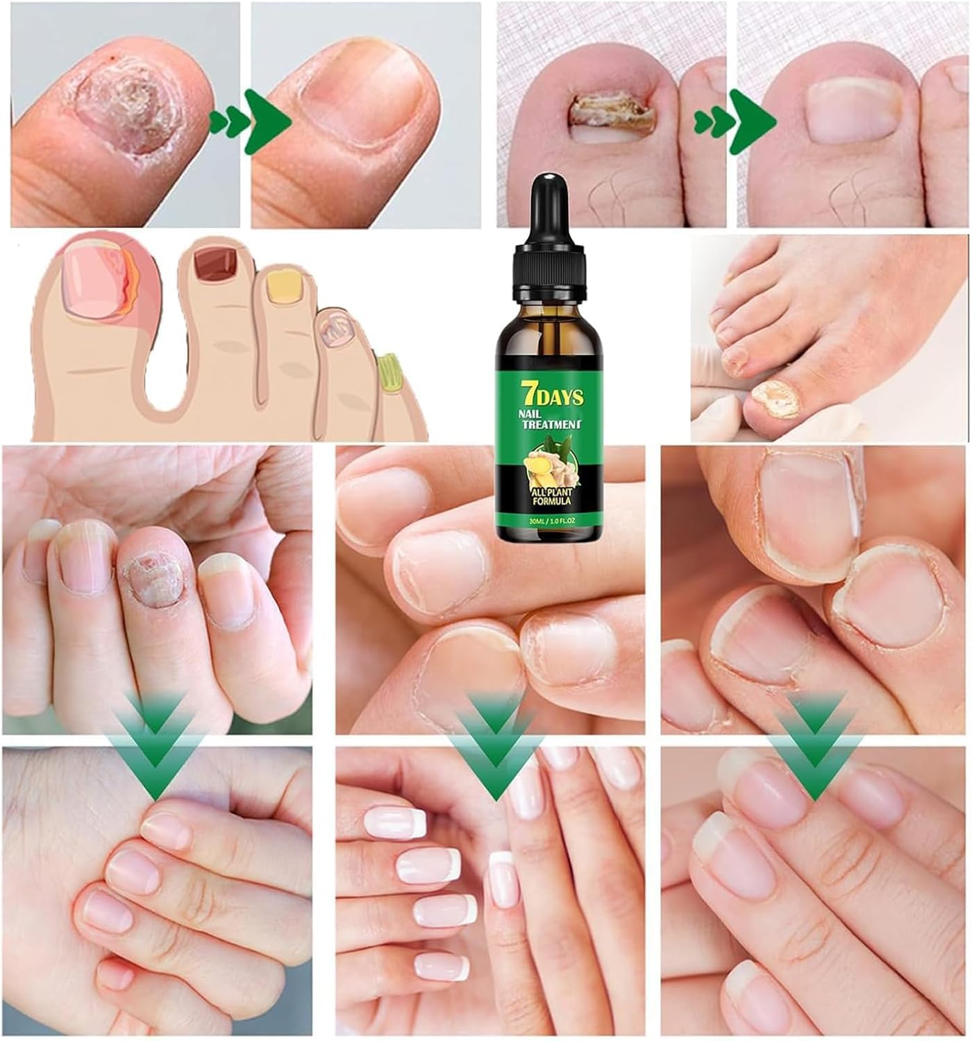 Ginger Nail Treatment Nail Support Nail Care, 7Days Nail Treatment Serum, Multipurpose Nail Repair, Ginger Nail Growth Serum, Nourishing Strengthening Nail Oil (1 PC)