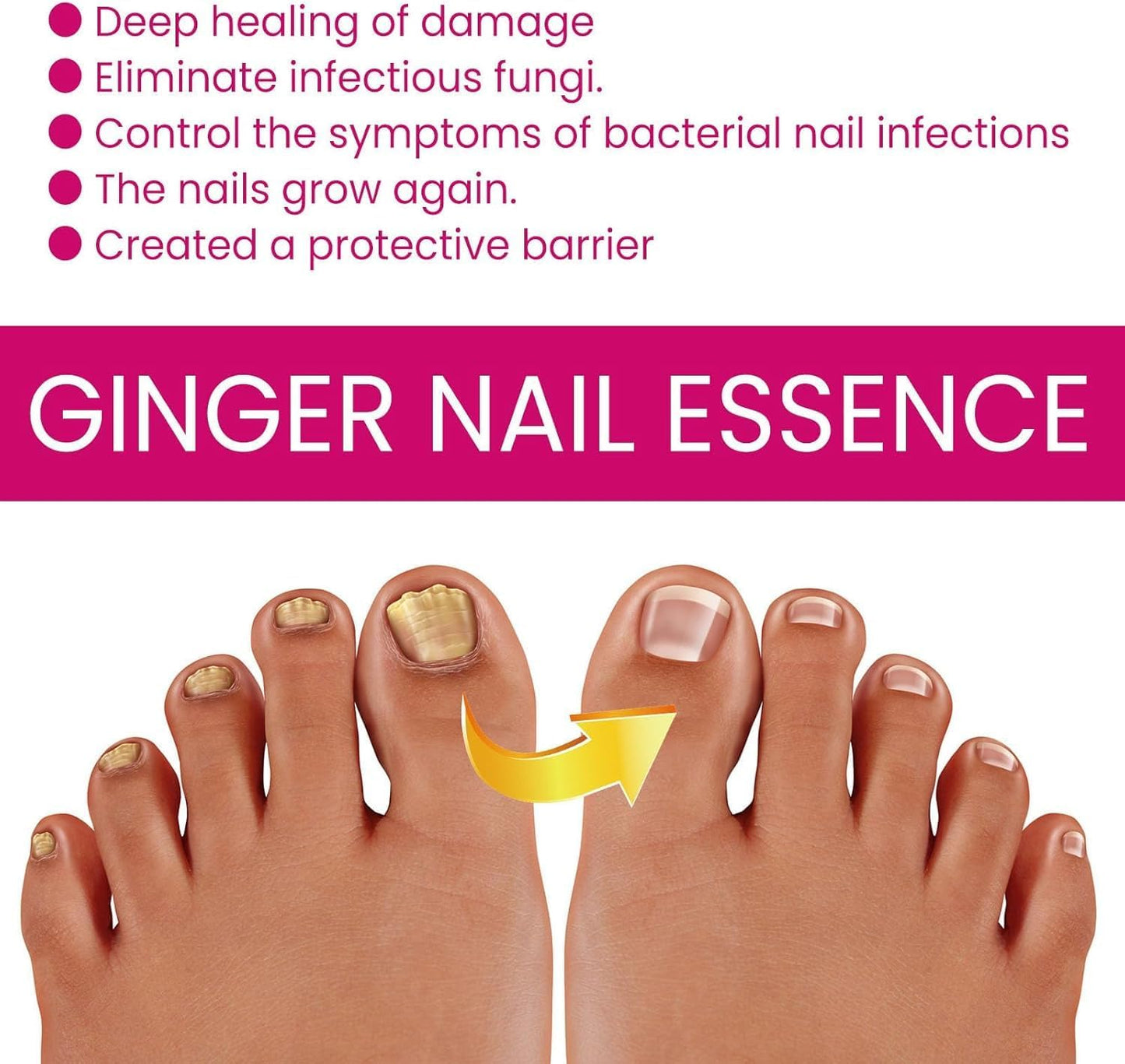 Fungigone Nail Treatment, Fungal Nail Care Strong Removal, Nail Repair Growth Treatment, Nail Softener for Thick Toenails Toe and Finger Nail Solution (1PCS)
