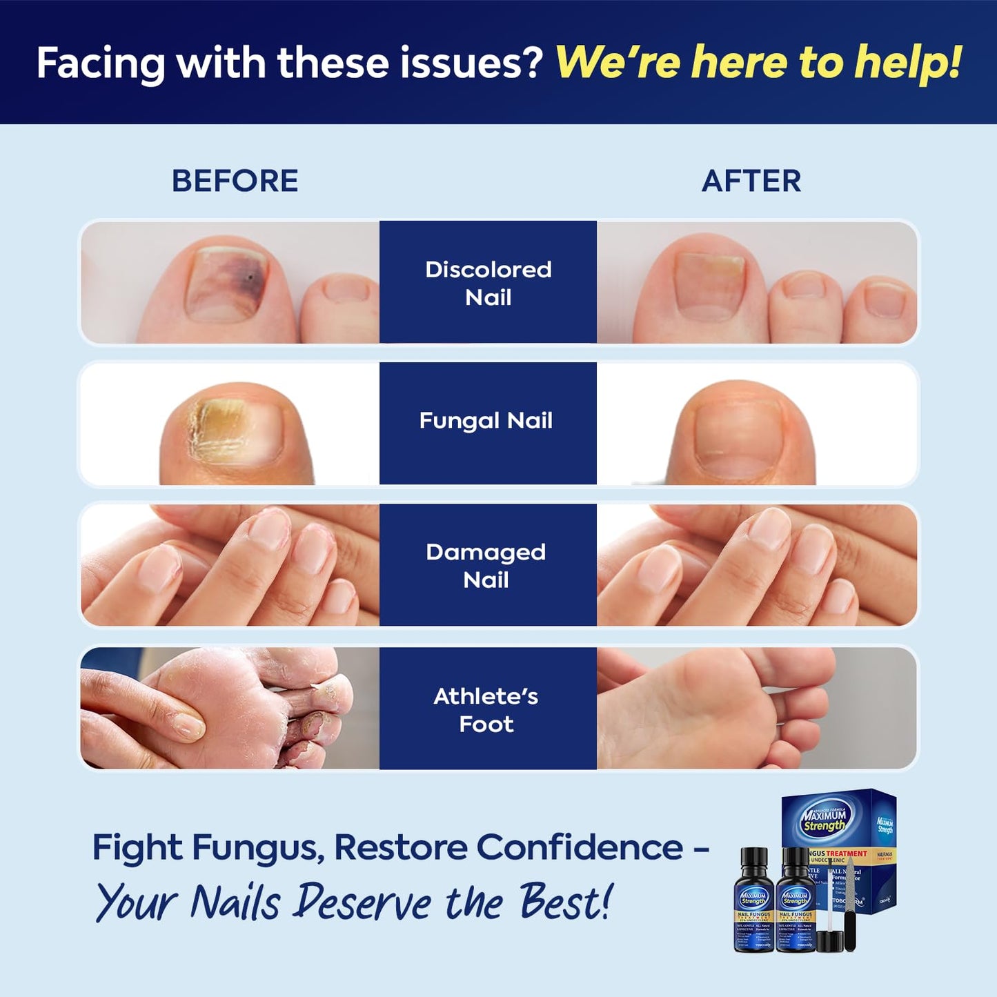 Toenail Fungus Treatment with 25% Undecylenic Acid, Toe Fungus Treatment for Toenail, Fungus Nail Treatment, Toenail Fungus Treatment Extra Strength, Fungal Nail Treatment for Athletes Foot (1oz)