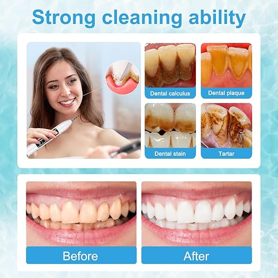 Plaque Tartar Remover for Teeth