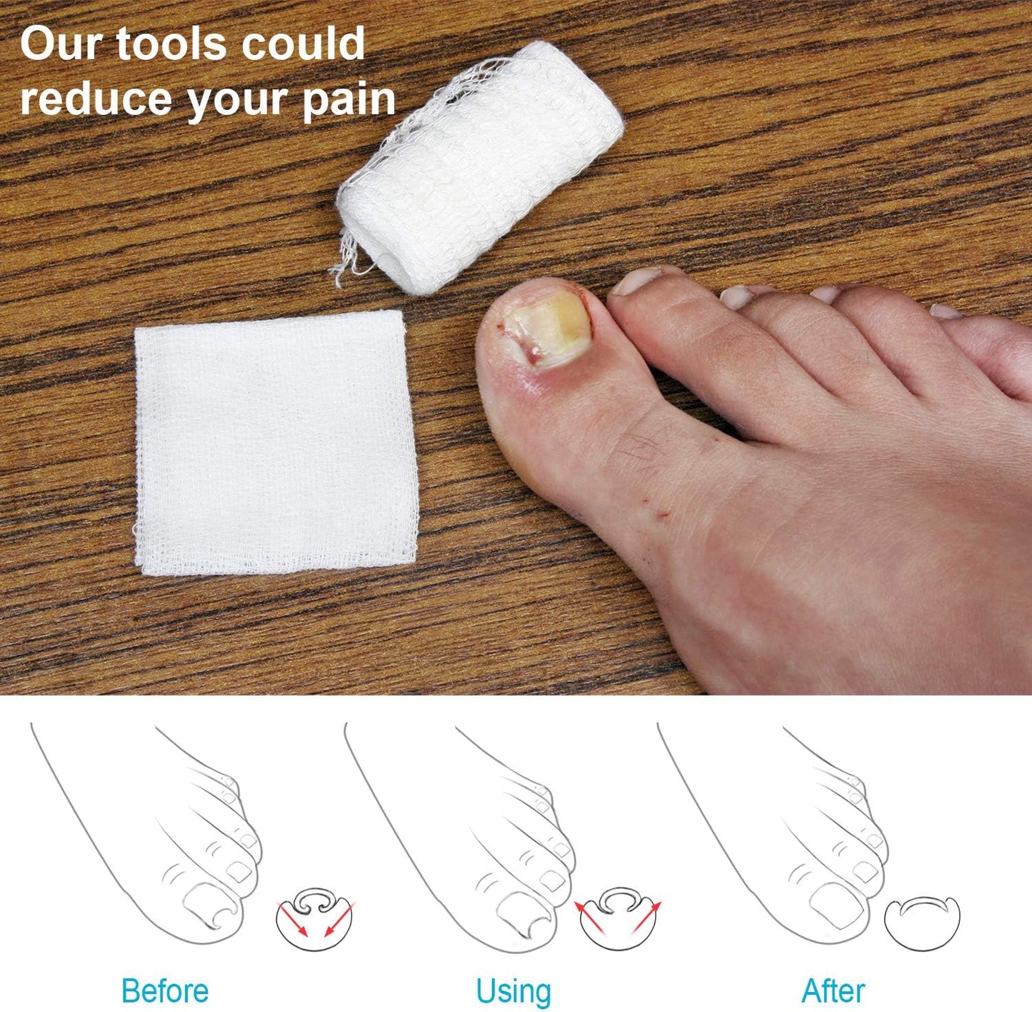 2 Pieces Ingrown Toenail Tool Ingrown Toenail Tool Stainless Steel Toe Cap Foot Care Tool for Paronychia (Gold)