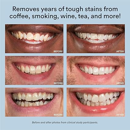 Auraglow Teeth Whitening Kit, LED Accelerator Light, 35% Carbamide Peroxide Teeth Whitening Gel, 20+ Whitening Treatments, Whitens up to 10 Shades in 7 Days