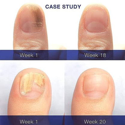Dr. Luke Toenail Fungus Revitalizer Tough on Nails: Nail Fungus Refresher Liquid for Discolored Nails 1 oz (Packaging May Vary)