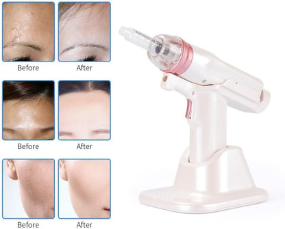 Dr.LPCGF Anti Wrinkle Injection Machine - Water Vacuum Gun - Facial Skin Care Beauty Device for Skin Rejuvenation,Moisturizing,Cleaning Pores and Blackheads