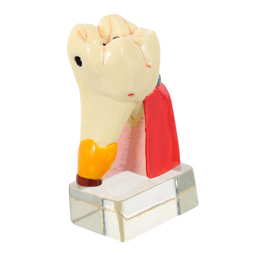 KICHOUSE 4 Caries Model Tooth Model Demonstration Model Teeth Model Teaching Oral Model Toy Teeth for Teeth Models for Education Model