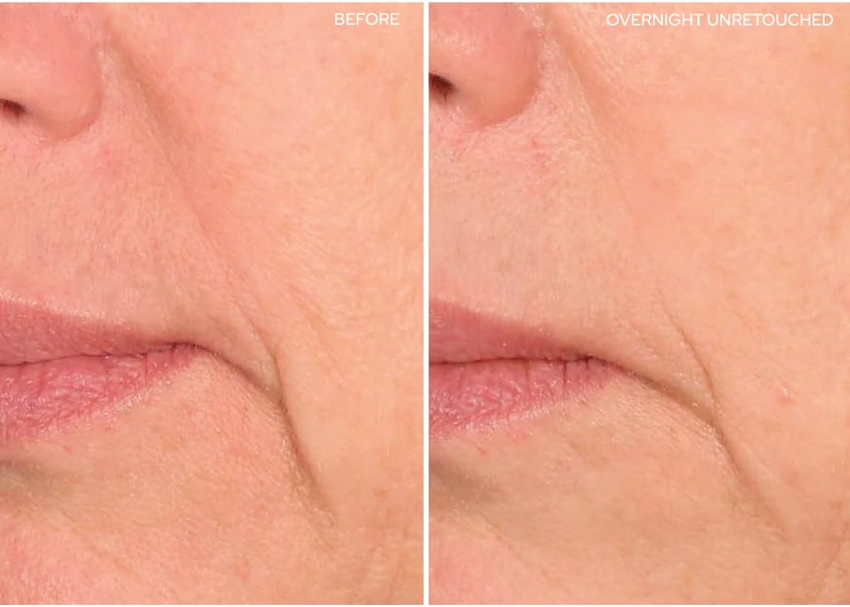 SiO Beauty Super LipLift - Smile & Lip Anti-Wrinkle Patches 2 Week Supply - Overnight Smoothing Silicone Patches For Lip & Smile Wrinkles And Fine Lines