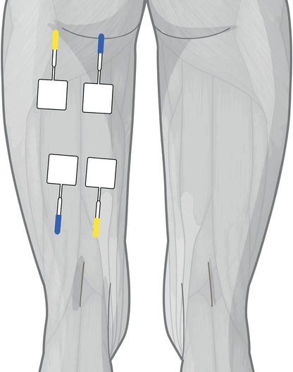 Globus | Genesy 3000, 4-Channel Electrostimulator with 423 Programs, Professional Use and Rehabilitation for Treatments of Musculoskeletal System Diseases