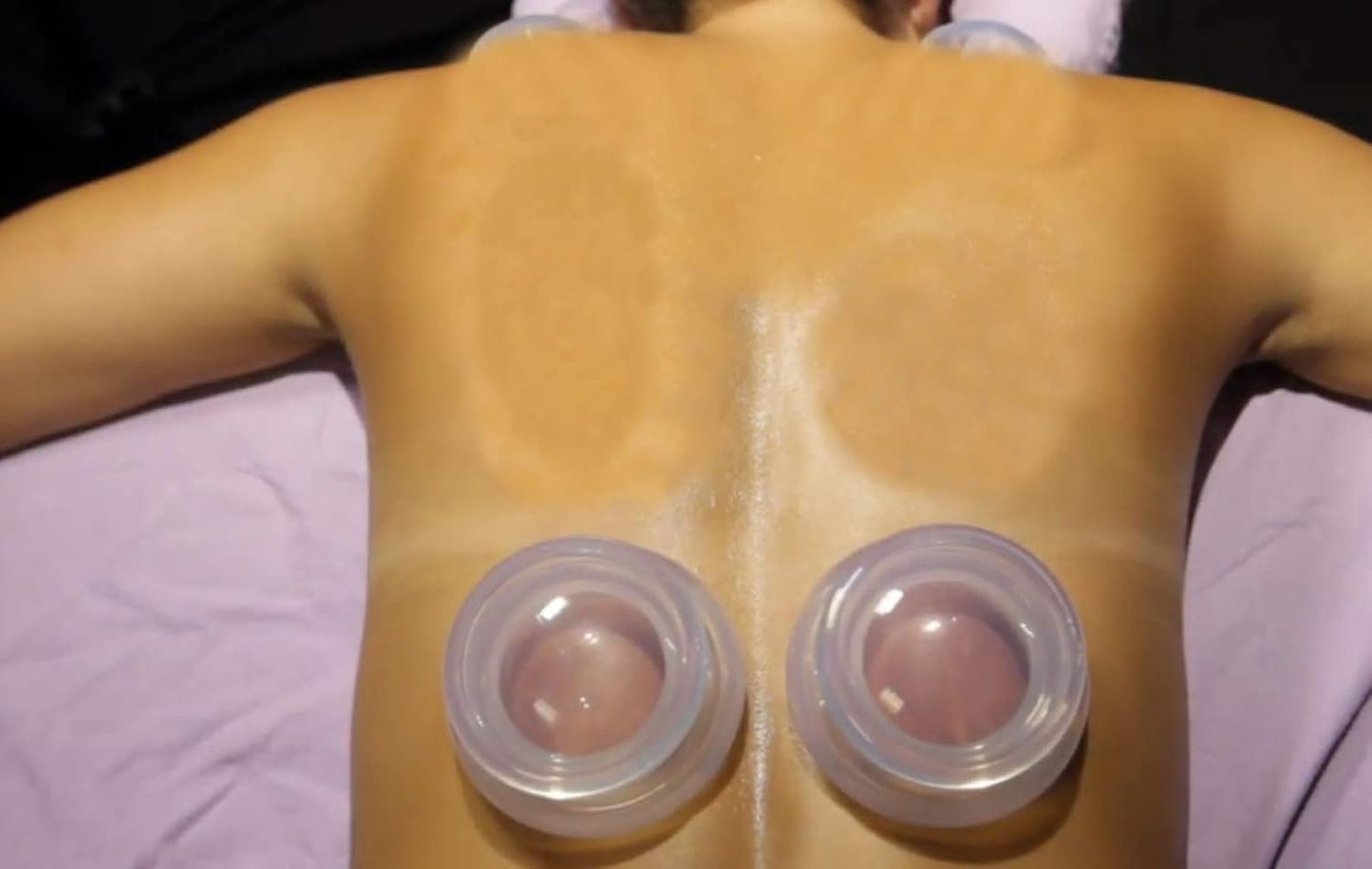 Professional Silicone Cupping Therapy Set 2pcs XL Vacuum Suction Massage Cups for Cellulite Treatment & Muscle Back Pain Relief & Injury Recovery Massager Single Use (Big Large)