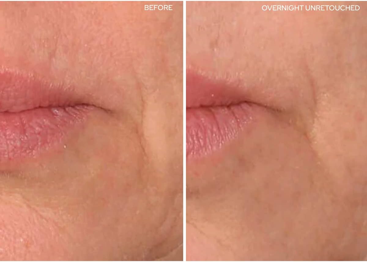 SiO Beauty Super LipLift - Smile & Lip Anti-Wrinkle Patches 2 Week Supply - Overnight Smoothing Silicone Patches For Lip & Smile Wrinkles And Fine Lines