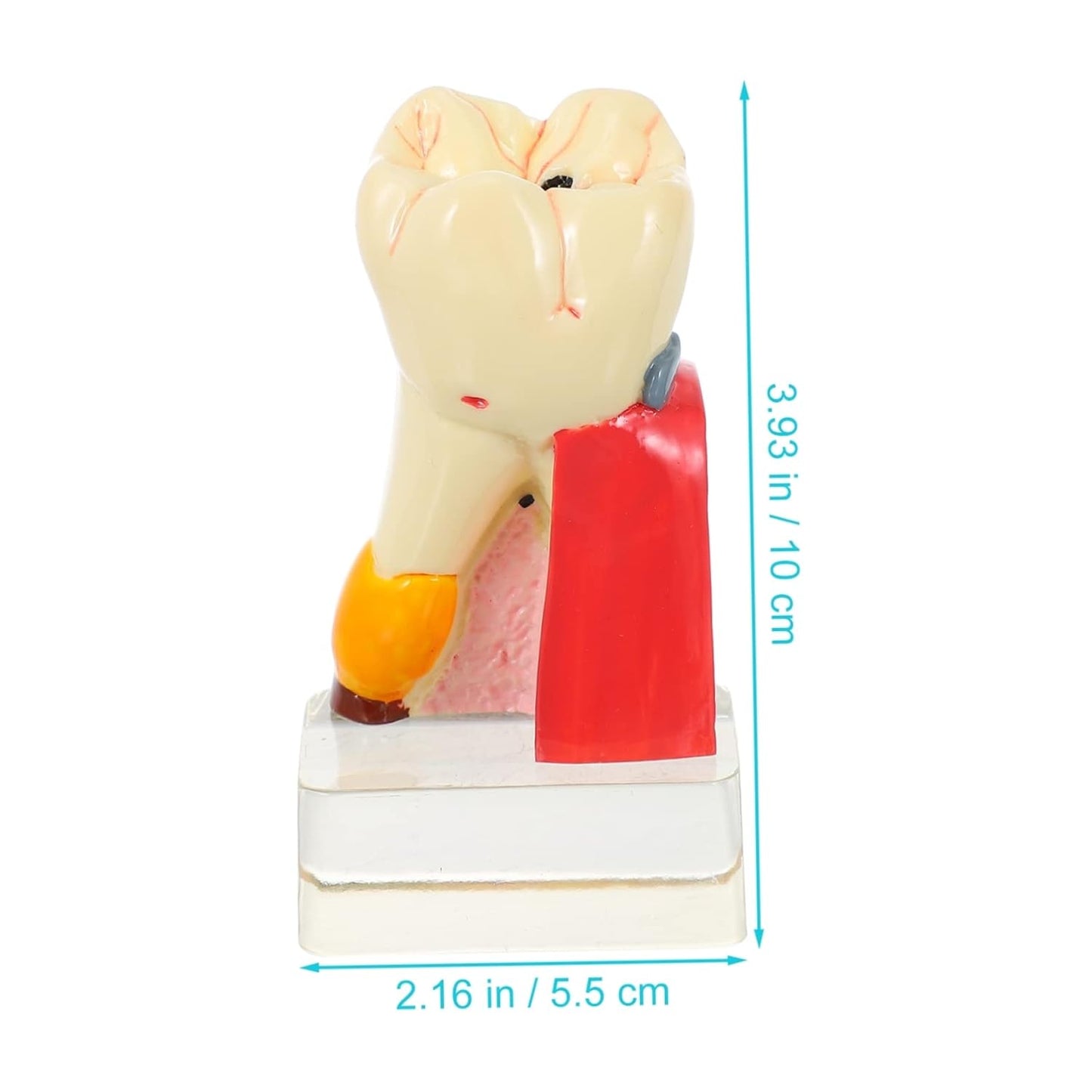 KICHOUSE 4 Caries Model Tooth Model Demonstration Model Teeth Model Teaching Oral Model Toy Teeth for Teeth Models for Education Model