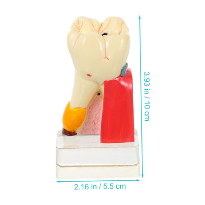 KICHOUSE 4 Caries Model Tooth Model Demonstration Model Teeth Model Teaching Oral Model Toy Teeth for Teeth Models for Education Model