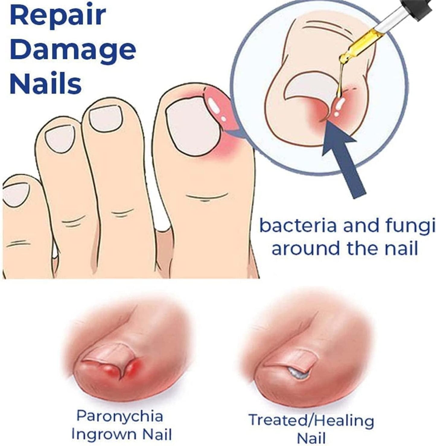 German Toenailcare Removal Paronychia Oil, Care Oil for Removing Paronychia, Toenail Treatment Best Nail Repair Solution,Nail Renewal Liquid for Damaged & Discoloration Nail (2 Pieces)
