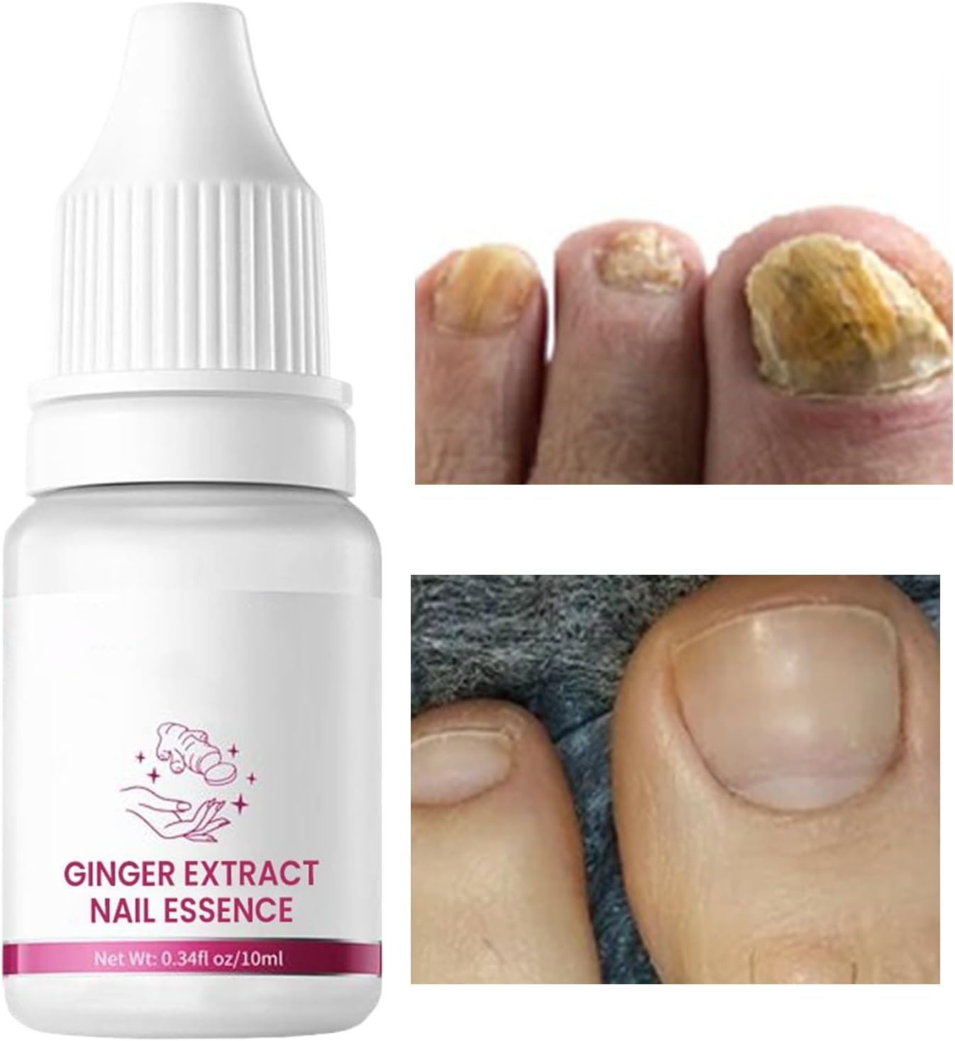Nail Hardener, Natural Nail Growth Oil, Cuticle Repair and Softener, Strengthening for Foot Care, Fingernails, Yellow and Ingrown Nail Recovery, 10 ml