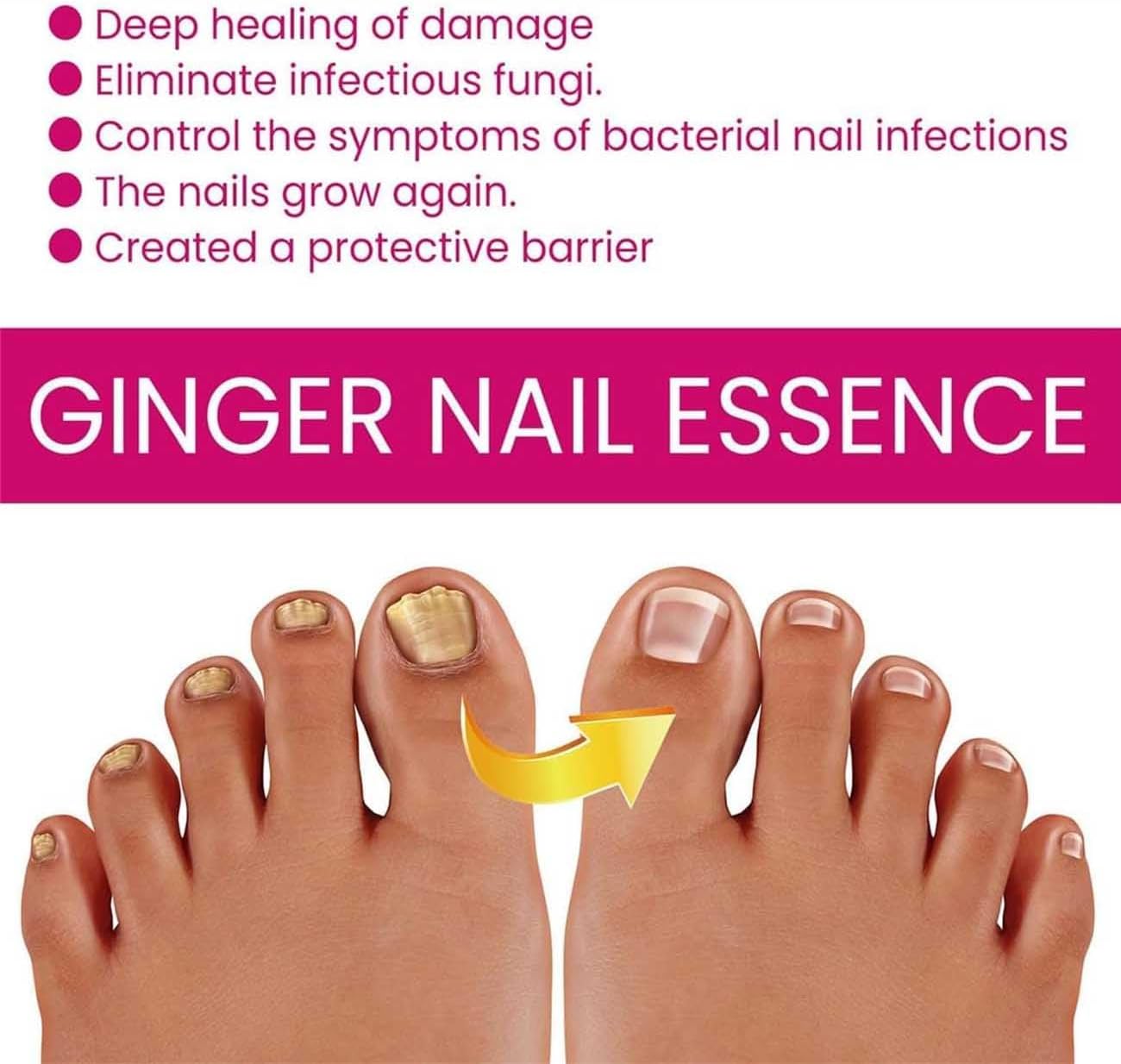 FungiGone Nail treatment,Fungigone Nail Fungus Removal,Fungal Nail Care Extra Strong Toe,Nail Repair Growth Treatment,Natural Nail Strengthener,Painless Fix And Renew Damaged,Broken Nails (2)