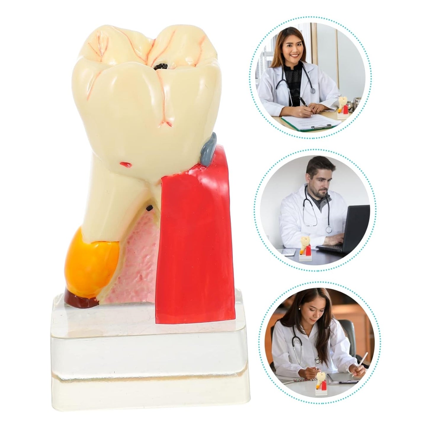 KICHOUSE 4 Caries Model Tooth Model Demonstration Model Teeth Model Teaching Oral Model Toy Teeth for Teeth Models for Education Model