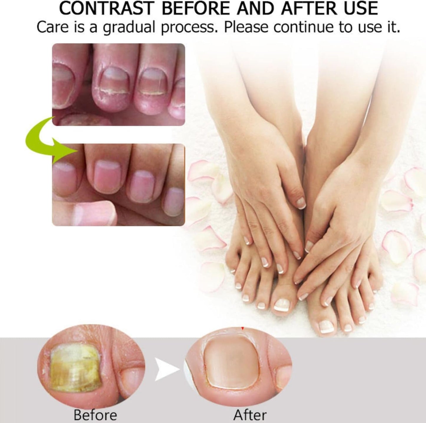 2PCS Nail Treatment Repair Gel, Fungal Nail Treatment Nail Repair Gel, Toe Be Health Instant 7 Days Beauty Gel, Toenail Treatment & Cure Under the Nail, for Damaged Nail.