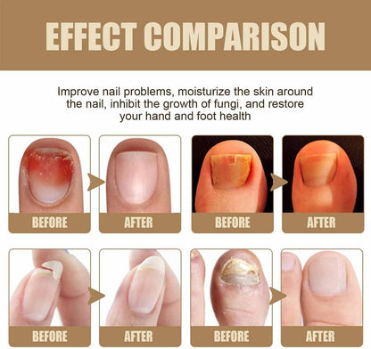 Swissclear - Antifungal Pen,Nail Care Pen,Fungal Nail Pen,Anti Fungal Nail Treatment,Natural Ingredients Toe Nail Fungal Serum for Strengthener,Repairs Cracks,and Corrects Deformed Nails (2)