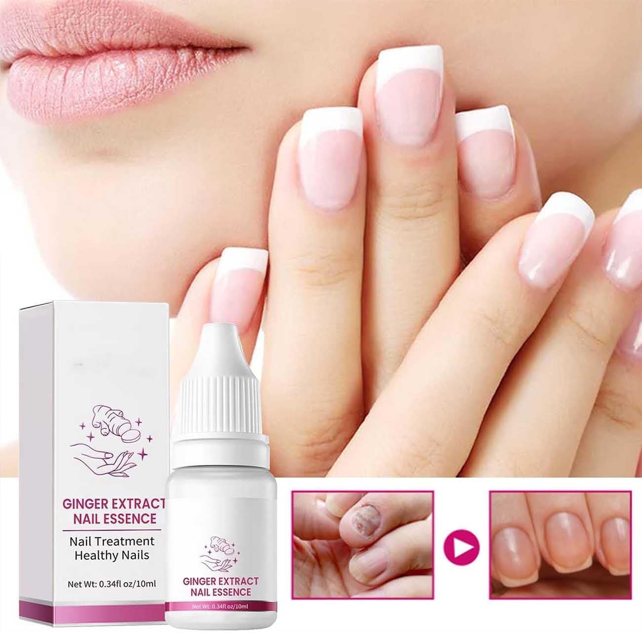 FungiGone Nail treatment,Fungigone Nail Fungus Removal,Fungal Nail Care Extra Strong Toe,Nail Repair Growth Treatment,Natural Nail Strengthener,Painless Fix And Renew Damaged,Broken Nails (2)