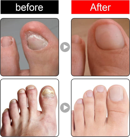 Nailhelper Ingrowth Toenail Correction Oil, Ingrown Toenail Drops, Nail & Cuticle Care, Ingrown Toenail Tool for Nail Repair (2pcs)
