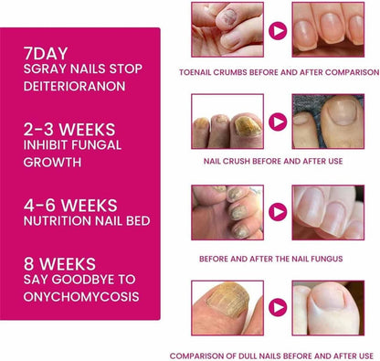 FungiGone Nail treatment,Fungigone Nail Fungus Removal,Fungal Nail Care Extra Strong Toe,Nail Repair Growth Treatment,Natural Nail Strengthener,Painless Fix And Renew Damaged,Broken Nails (2)