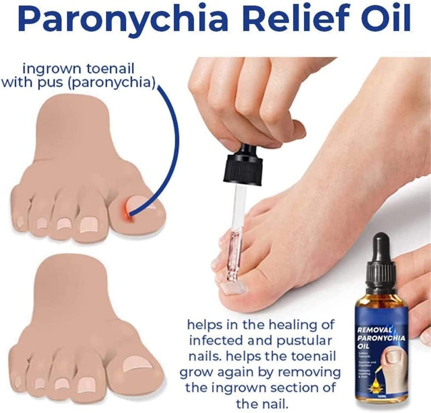 German Toenailcare Removal Paronychia Oil, Care Oil for Removing Paronychia, Toenail Treatment Best Nail Repair Solution,Nail Renewal Liquid for Damaged & Discoloration Nail (2 Pieces)