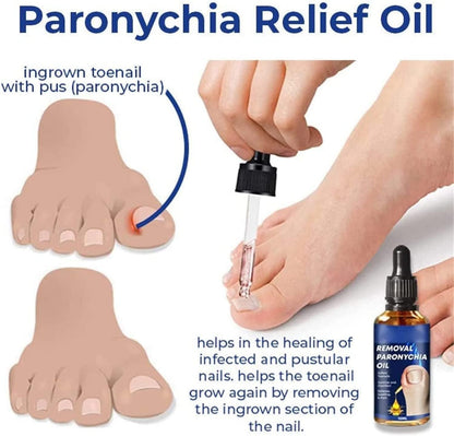 German Toenailcare Removal Paronychia Oil, Care Oil for Removing Paronychia, Toenail Treatment Best Nail Repair Solution,Nail Renewal Liquid for Damaged & Discoloration Nail (2 Pieces)
