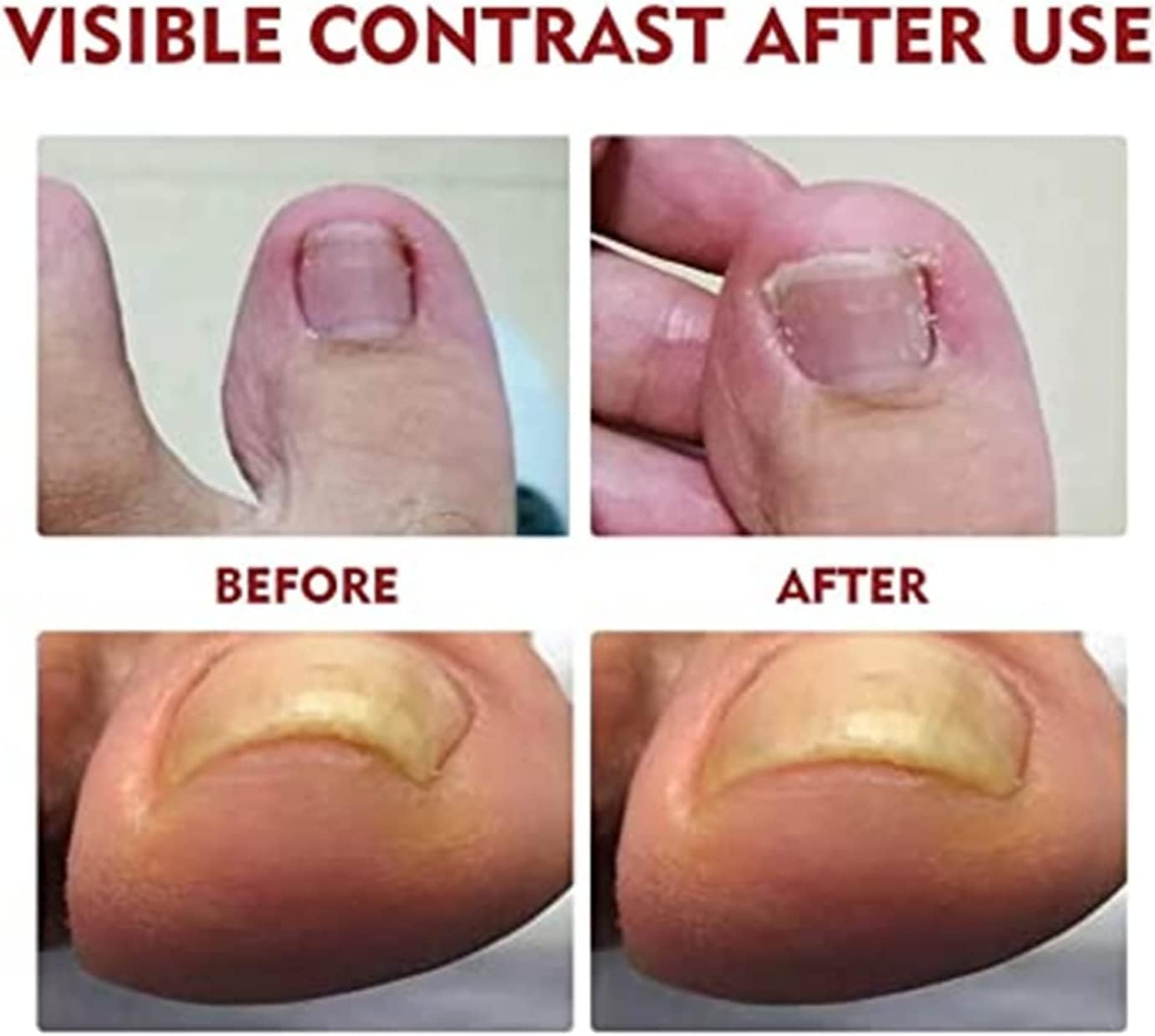 German Toenailcare Removal Paronychia Oil, Care Oil for Removing Paronychia, Toenail Treatment Best Nail Repair Solution,Nail Renewal Liquid for Damaged & Discoloration Nail (2 Pieces)