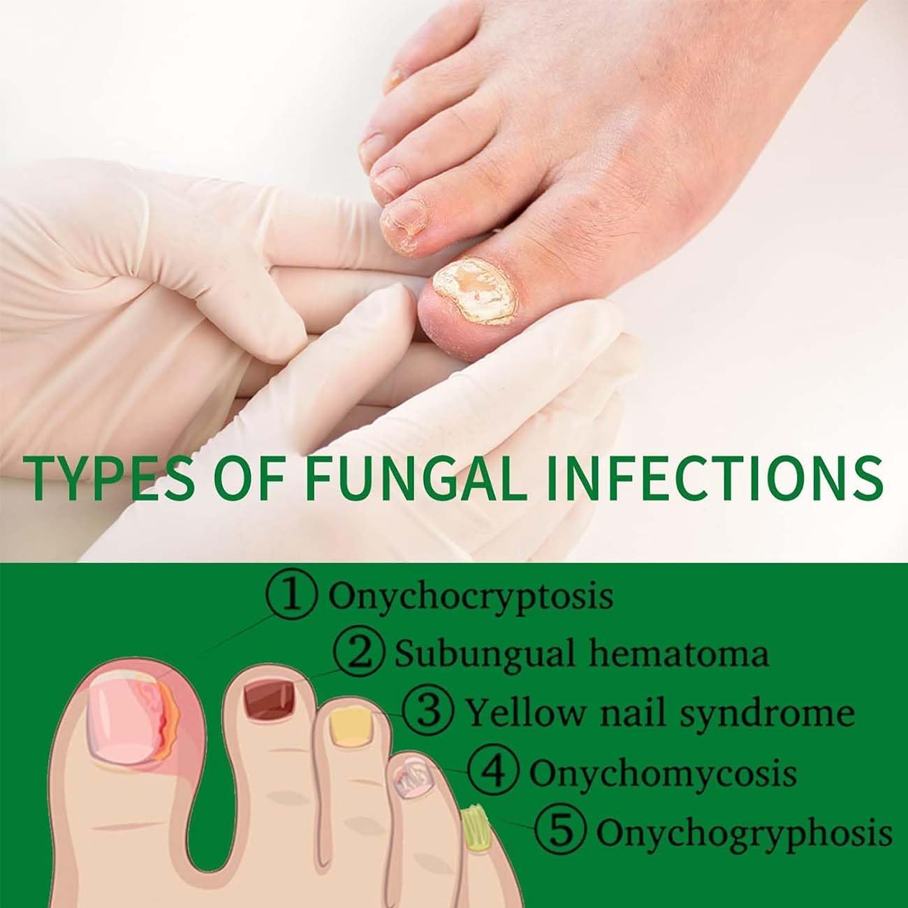Nailshield Anti Fungal Stick, Anti Fungal Stick Roll On, Fungal Nail Repair Stick, Natural Nail Strengthener, Say Goodbye To Nail Fungus, For Nail Care Serum, Prevents Hangnails And Dryness (2)