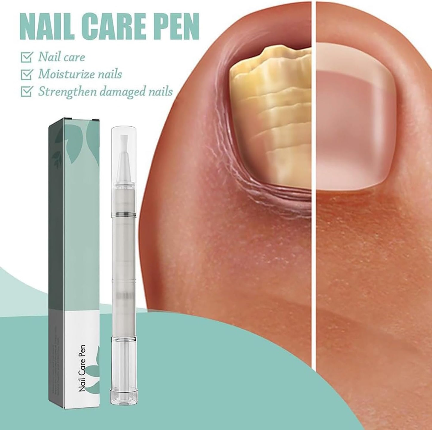 Mullend Nail Care Pen, Nail Fungus Treatment for Toenail, Anti Fungas Nail Strengthener for Ingrown & Thick Nail Infaction Treatmant (1 PC)