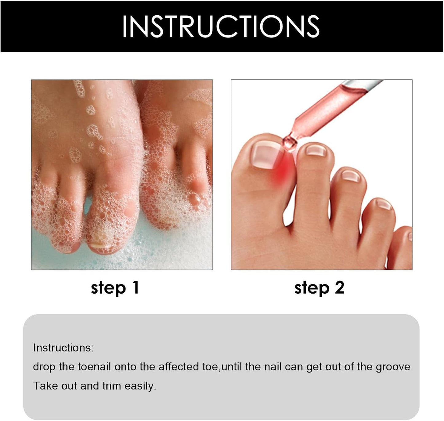Ingrown Toenail Treatment Drop - Ingrown Toenail Treatment- Cuticle Care Oils for Ingrown Toenails - Trimming Toenail Softening Drops Natural Ingrown Toenail Correction Fungal Nail - 10ml