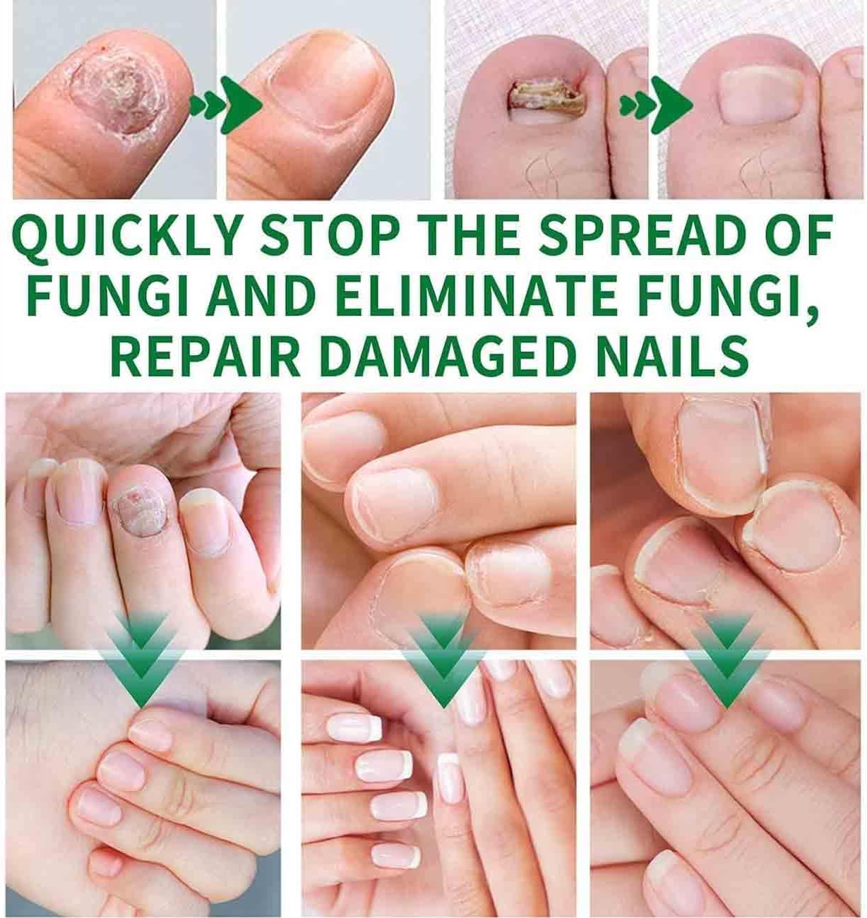 Nailshield Anti Fungal Stick, Anti Fungal Stick Roll On, Fungal Nail Repair Stick, Natural Nail Strengthener, Say Goodbye To Nail Fungus, For Nail Care Serum, Prevents Hangnails And Dryness (2)