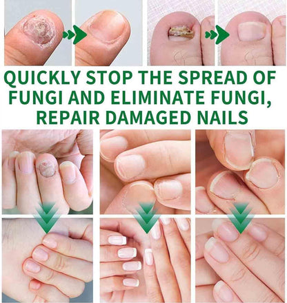Nailshield Anti Fungal Stick, Anti Fungal Stick Roll On, Fungal Nail Repair Stick, Natural Nail Strengthener, Say Goodbye To Nail Fungus, For Nail Care Serum, Prevents Hangnails And Dryness (2)