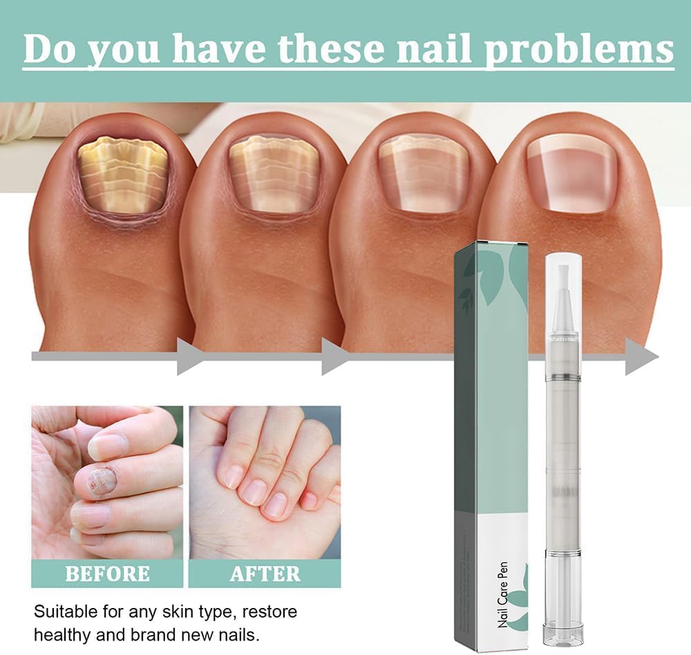 Mullend Nail Care Pen, Nail Fungus Treatment for Toenail, Anti Fungas Nail Strengthener for Ingrown & Thick Nail Infaction Treatmant (1 PC)