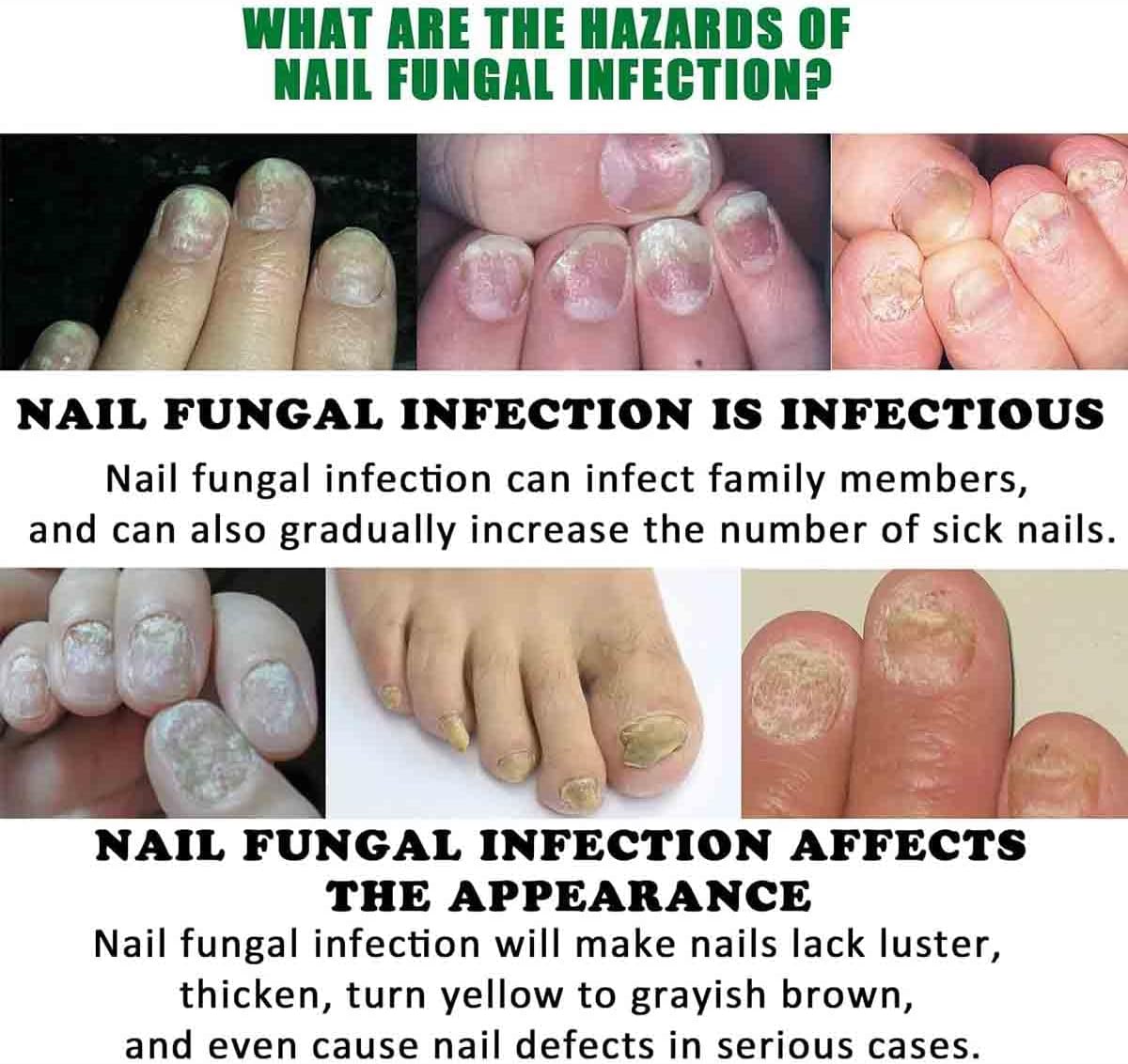 Nailshield Anti Fungal Stick, Anti Fungal Stick Roll On, Fungal Nail Repair Stick, Natural Nail Strengthener, Say Goodbye To Nail Fungus, For Nail Care Serum, Prevents Hangnails And Dryness (2)
