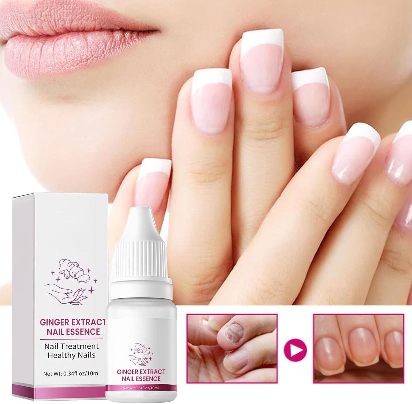Fungigone Nail Treatment, Fungal Nail Care Strong Removal, Nail Repair Growth Treatment, Nail Softener for Thick Toenails Toe and Finger Nail Solution (1PCS)