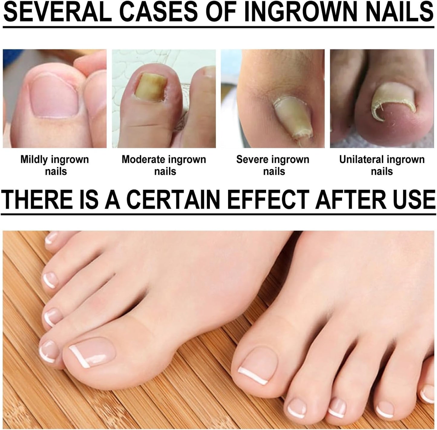 Ingrown Toenail Treatment Drop - Ingrown Toenail Treatment- Cuticle Care Oils for Ingrown Toenails - Trimming Toenail Softening Drops Natural Ingrown Toenail Correction Fungal Nail - 10ml