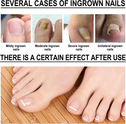 Ingrown Toenail Treatment Drop - Ingrown Toenail Treatment- Cuticle Care Oils for Ingrown Toenails - Trimming Toenail Softening Drops Natural Ingrown Toenail Correction Fungal Nail - 10ml