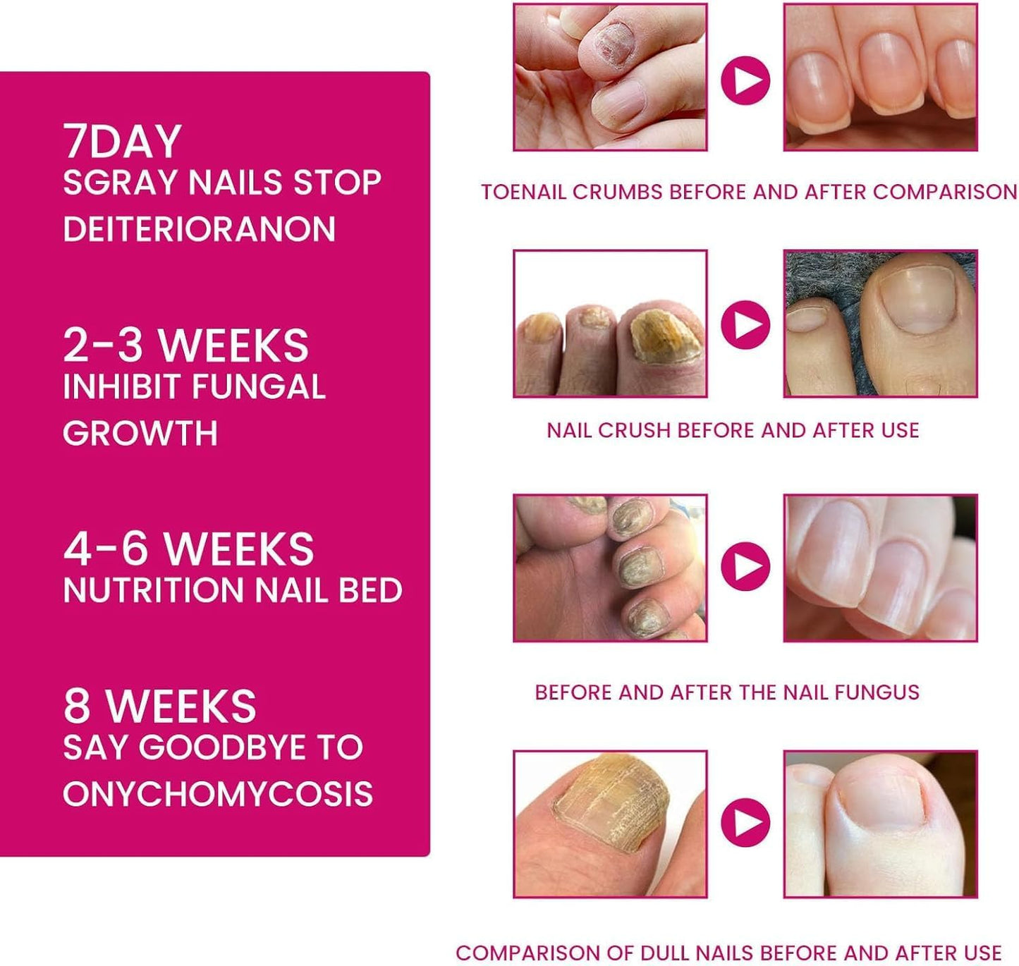 Fungigone Nail Treatment, Fungal Nail Care Strong Removal, Nail Repair Growth Treatment, Nail Softener for Thick Toenails Toe and Finger Nail Solution (1PCS)