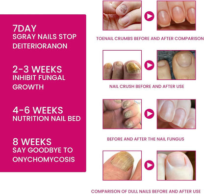 Fungigone Nail Treatment, Fungal Nail Care Strong Removal, Nail Repair Growth Treatment, Nail Softener for Thick Toenails Toe and Finger Nail Solution (1PCS)