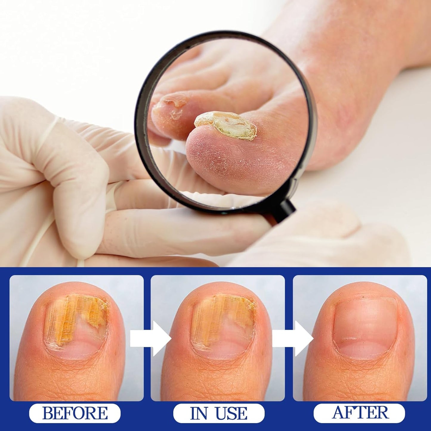 Apooliy 30ML Toenail Fungus Treatment Extra Strength, Powerful Nail Care Renewal & Recovery Liquid for Thick, Damaged & Discolored Nails Remedy
