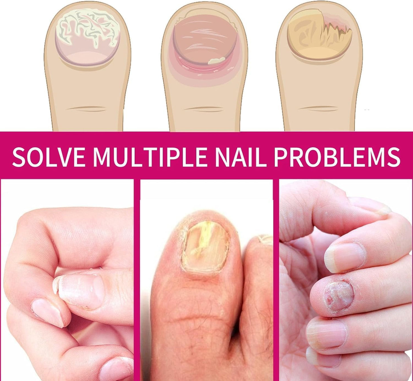 Fungigone Nail Treatment, Fungal Nail Care Strong Removal, Nail Repair Growth Treatment, Nail Softener for Thick Toenails Toe and Finger Nail Solution (1PCS)