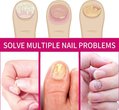 Fungigone Nail Treatment, Fungal Nail Care Strong Removal, Nail Repair Growth Treatment, Nail Softener for Thick Toenails Toe and Finger Nail Solution (1PCS)